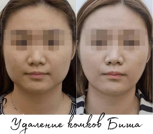 Удаление комков Биша — фото 1